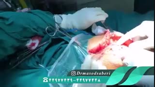مراحل مقدماتی تعویض مفصل زانو