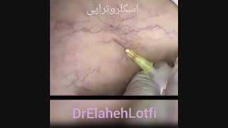 اسکلروتراپی ترمیم ونیر