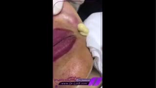 تخلیه ژل نامرغوب هایفوتراپی