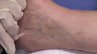 اسکلرو تراپی . دکتر مقیمی