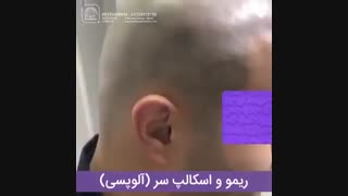 میکرواسکالپ فرد مبتلا به آلوپسی