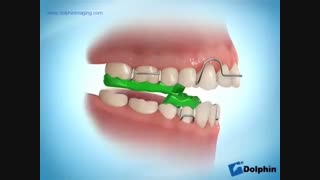 دستگاه تویین بلاک
