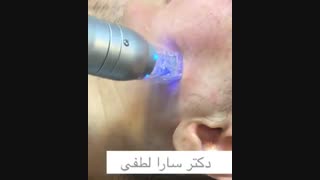جوانسازی صورت با دستگاه آر اف برداشتن خال