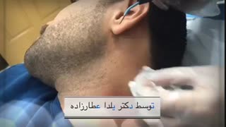 برداشتن خال کاشت مو