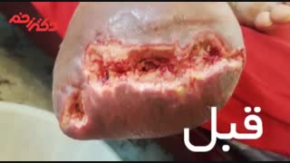 درمان عفونت و زخم محل قطع عضو در بیمار دیابتی توسط کلینیک دکتر زخم