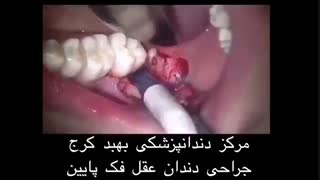 جراحی دندان عقل