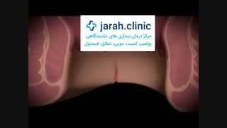 روش های درمان شقاق