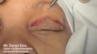 بلفاروپلاستی یا برطرف کردن پف پلک