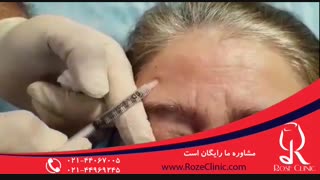 تزریق بوتاکس | فیلم تزریق بوتاکس | کلینیک پوست و مو رز7