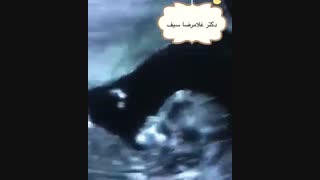 سونوگرافی جنین