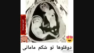 سونوگرافی دوقلو