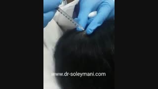 مزوتراپی موی سر