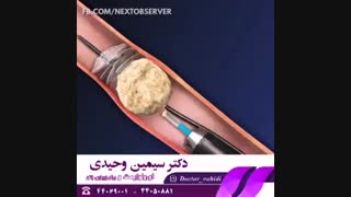 درمان سنگ کلیه