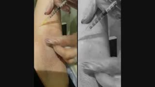 تزریق بوتاکس زیر بغل