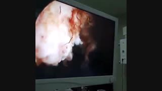 جراحی آندوسکوپی تومور بدخیم مثانه