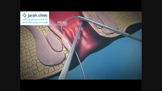 نشانه ها و علائم فیستول مقعد