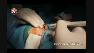 عمل جراحی اکتروپیون چشم