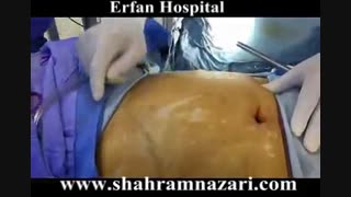 بای پاس لاپاروسکوپیک معده پس از دو بار شکست عمل اسلیو