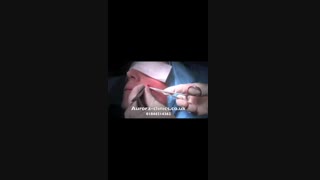 جزاحی خال (۲) .دکتر ابراهیم مقیمی