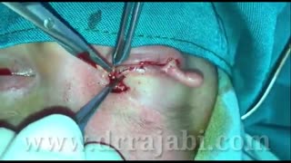 کلوبوم یا عدم تشکیل پلک فوقانی به صورت مادرزادی