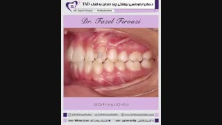 دندان نهفته | دکتر فاضل فیروزی