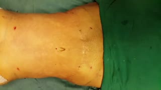لیپوماتیک - دکتر ابدالی - 22807060 کاشت مو