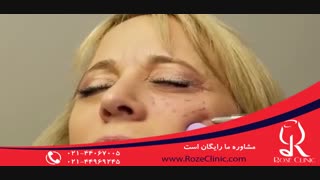 تزریق بوتاکس | فیلم تزریق بوتاکس | کلینیک پوست و مو رز9