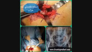 جراحی تعویض کامل مفصل لگن سمت راست