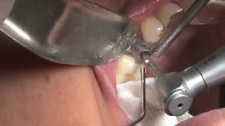 فرآیند کاشت ایمپلنت با لیزر-کلینیک دندانپزشکی