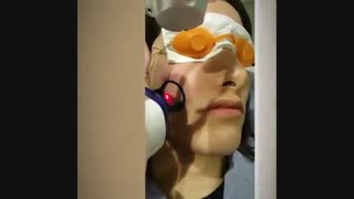 لیزر co2 فرکشنال