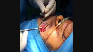 جراحی پلک با بی حسی موضعی
