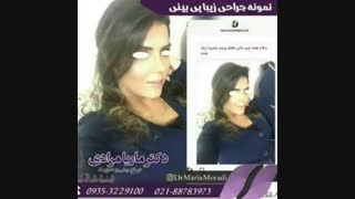 نمونه جراحی های زیبایی بینی در یک نگاه