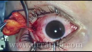 جراحی تومور لیپودرموئید