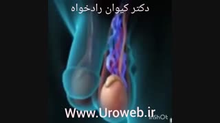 واریکوسل