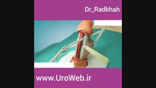 جراحی افزایش سایز آلت