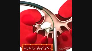سنگ کلیه