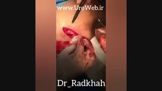 عمل جراحی بیضه نزول کرده