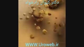 سنگ کلیه