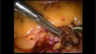 جراحی لاپاراسکوپی سنگ حالب توسط دکتر مو سی نژاد