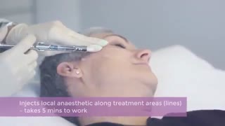 نخ لیفت pdo روشی بدون جراحی برای زیبایی و صافی پوست