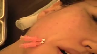 لیفت صورت با نخ برای جوانسازی و جلوگیری از پیری