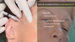 آموزش تزریق ژل فیلر الانسه کامپوزیت ونیر