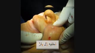 تخلیه ژل پاژ