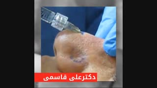 تزریق ژل به بینی