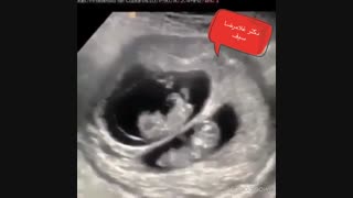 سونوگرافی بارداری دو قلو