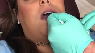 نگاهی به تزریق ژل فیلر ژوویدرم  اولتر به لب و نتایج پس از آن