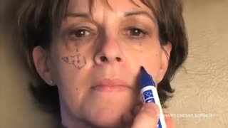 آموزشی گام به گام در مورد چگونگی علامت گذاری و تزریق فیلر به صورت