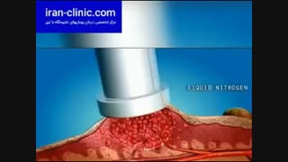 درمان زگیل تناسلی با لیزر در ایران کلینیک