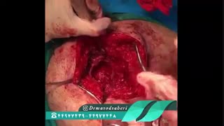 تعویض مفصل لگن