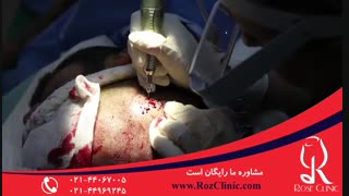 کاشت مو | فیلم کاشت مو | کلینیک پوست و مو رز | شماره 17